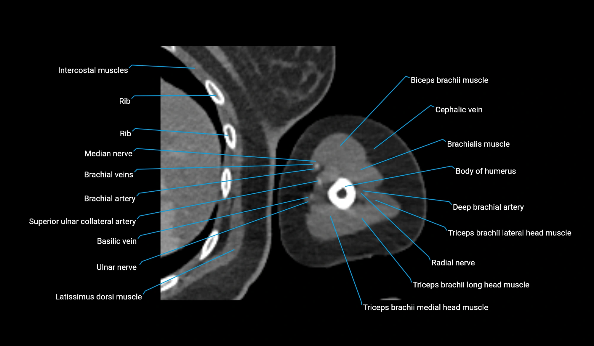 CT upper arm axial  cross sectional anatomy labelled radiology image -00274.webp